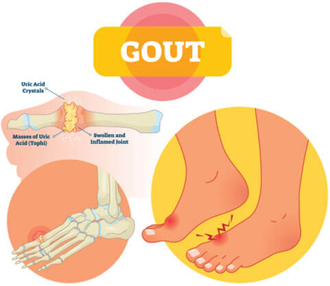 Gout, gout pain, gout treatment, gout flares, painful gout, gout attacks diagnostics in Reisterstown, Owings Mills & Towson, MD
