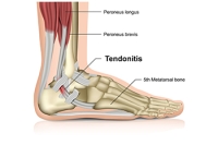How Tendonitis Can Affect the Foot