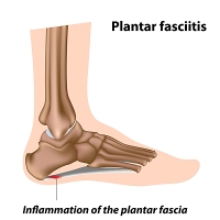 What Causes Plantar Fasciitis