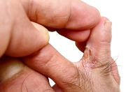 How Does The Fungus That Causes Athlete’s Foot Enter the Body?