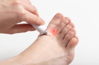 What Are the Symptoms of Athlete’s Foot?
