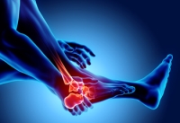Rheumatoid Arthritis Can Affect Both Feet