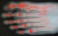 Facts About Rheumatoid Arthritis