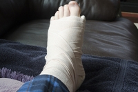 Broken Foot Cast