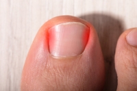 Why Do I Have an Ingrown Toenail?