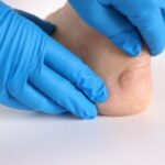 md gout institute gout treatment in westminster